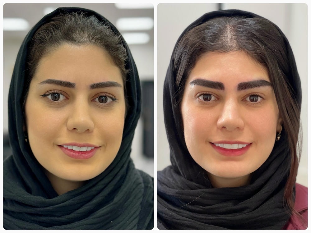 نتیجه درمان جوانسازی پوست