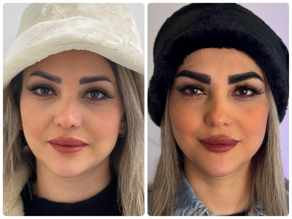 نتیجه تزریق بوتاکس