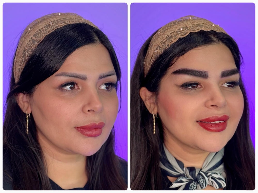 نتیجه تزریق فیلر