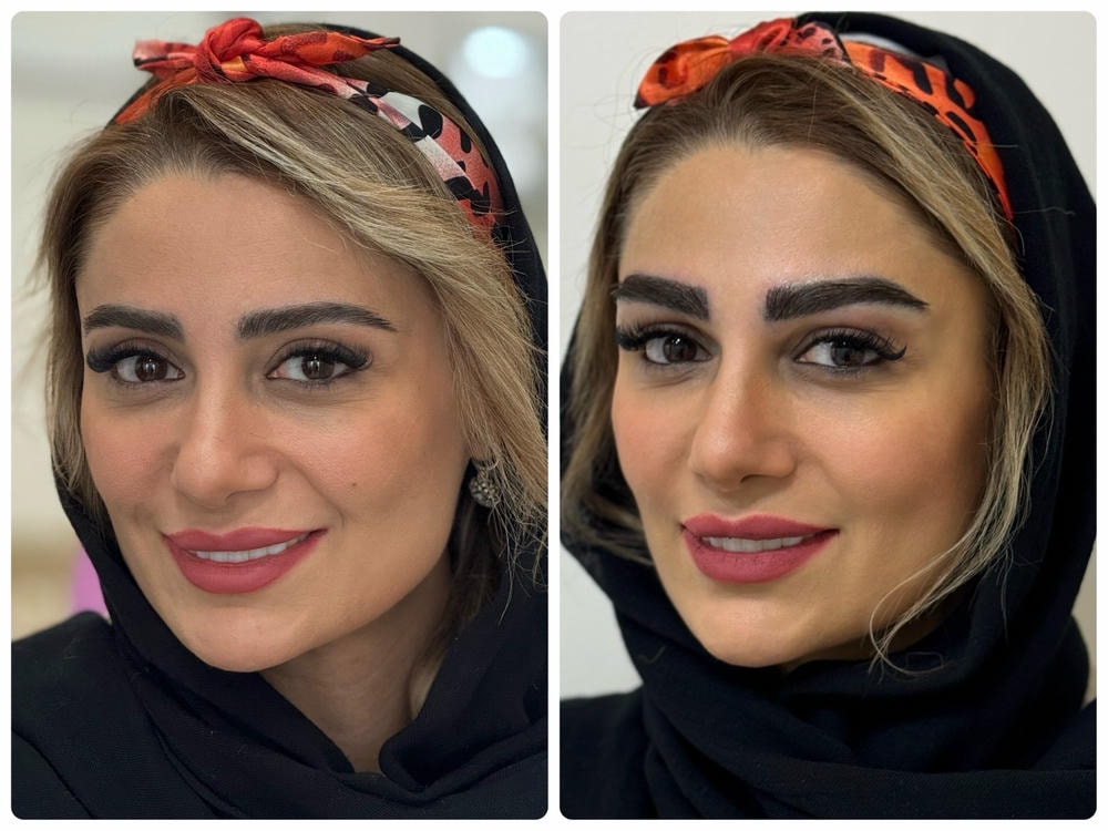 نتیجه لیزر پوست