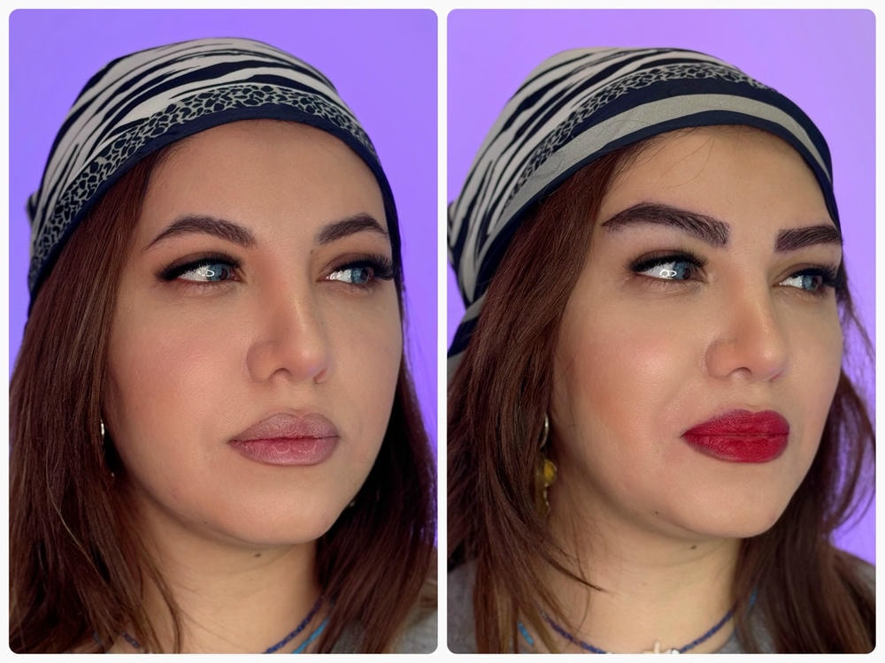 نتیجه درمان آکنه